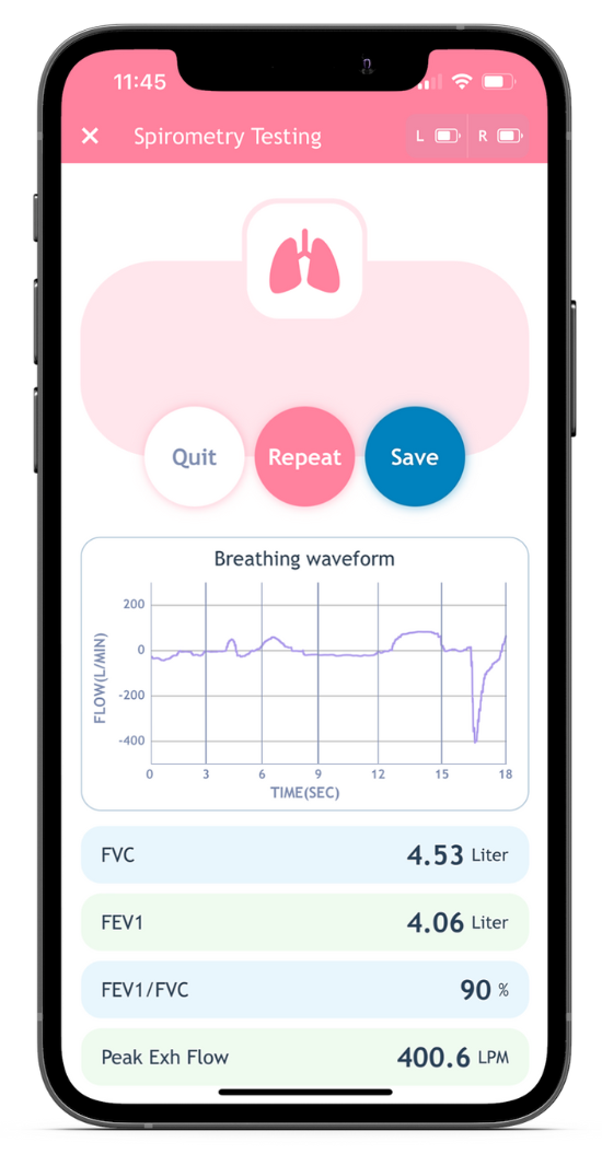 Spirometry Testing for Asthma Monitoring via Aimwell AYO BT+